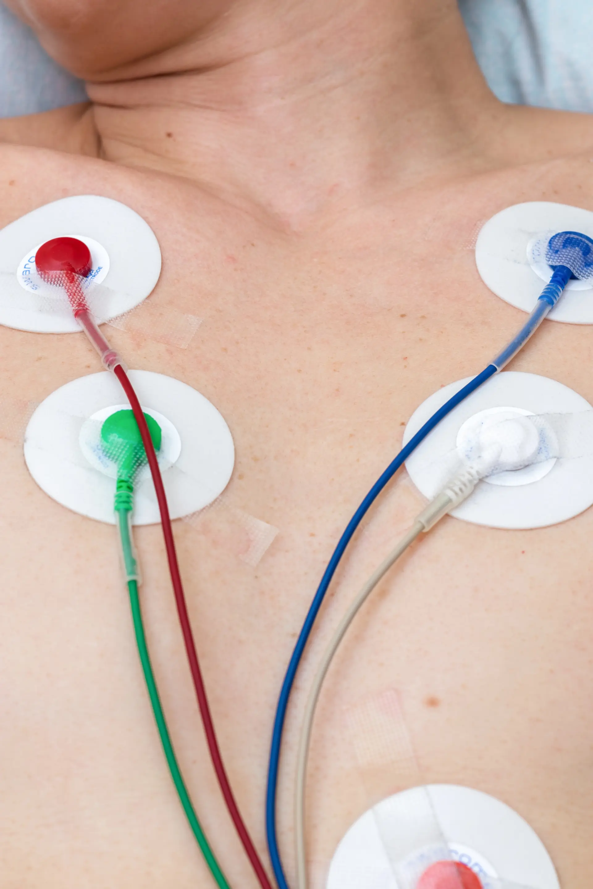 Brust mit angelschlossenen Elektrokardiographie Elektroden